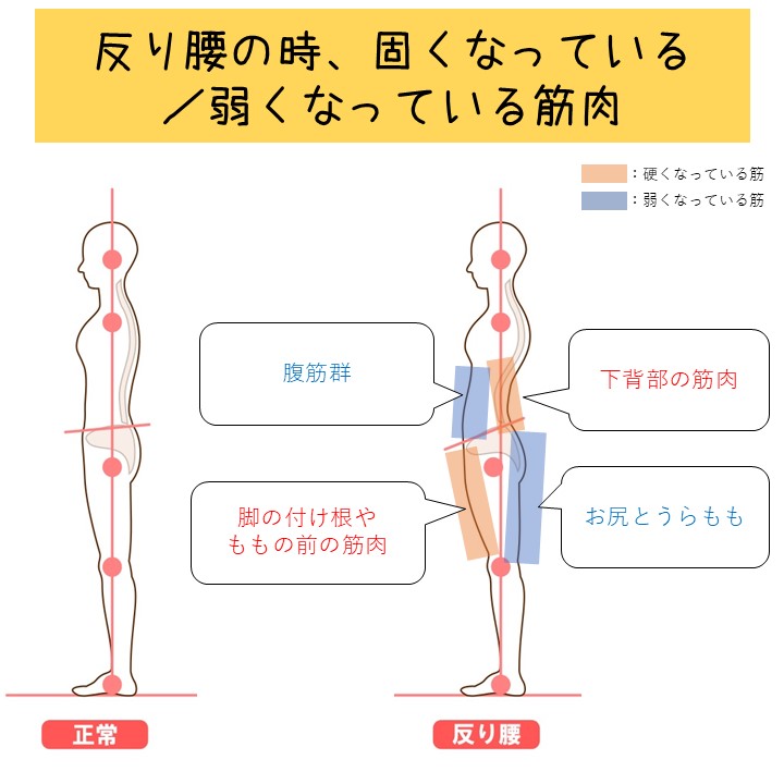 反り腰の原因は筋肉！腰痛の原因にもなる反り腰を改善するには？