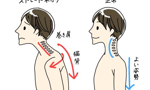 猫背・巻き肩になりやすい人は？原因を把握してストレッチしてみよう