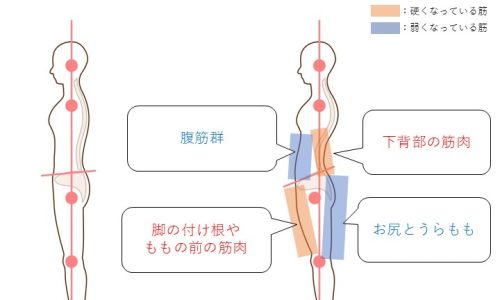 反り腰の原因は筋肉！腰痛の原因にもなる反り腰を改善するには？